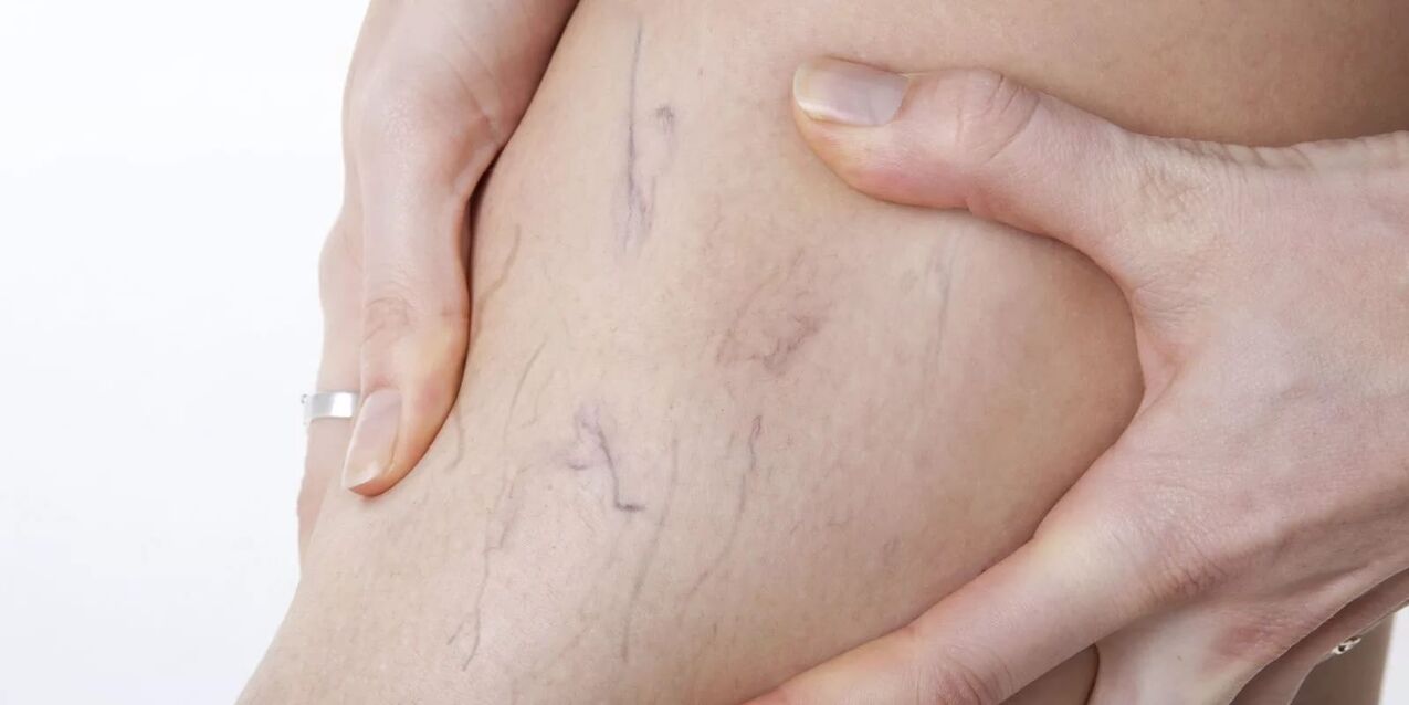 A varicone krém használata előtt